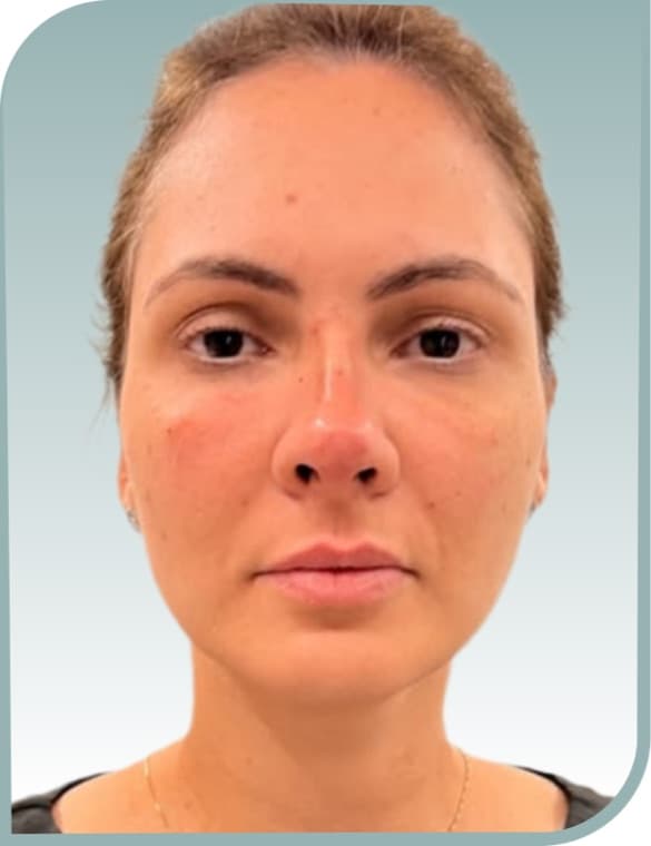 Central redness, Before photo (result 3 of 10)