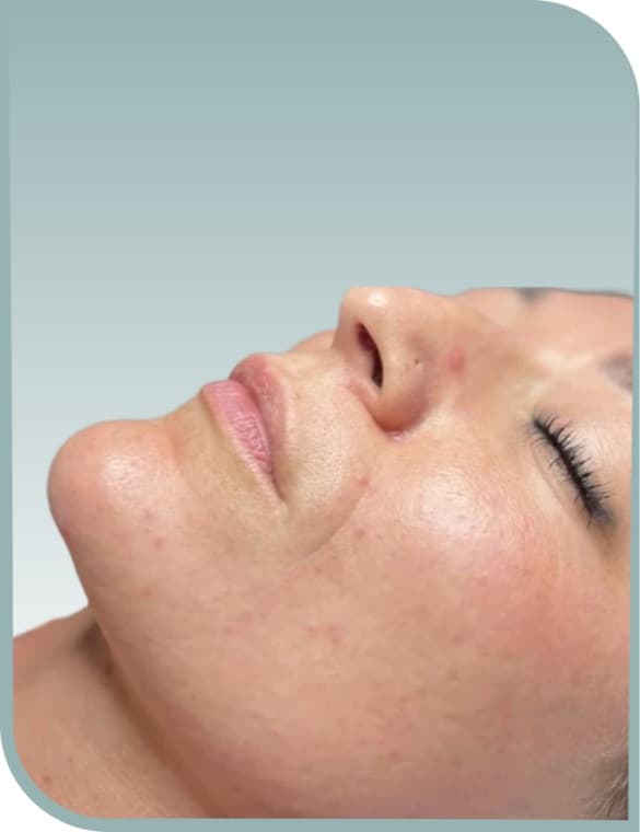 Chin and lip area, Before photo (result 5 of 10)