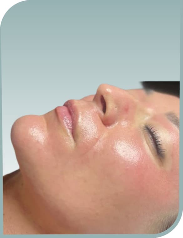 Chin and lip area, After photo (result 5 of 10)