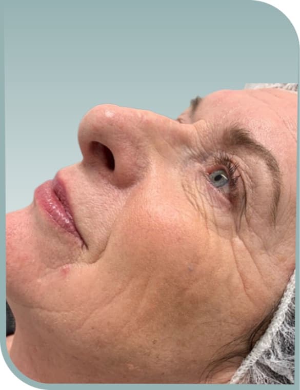 Fine lines, Before photo (result 7 of 10)