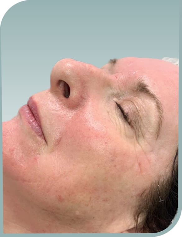 Fine lines, After photo (result 7 of 10)