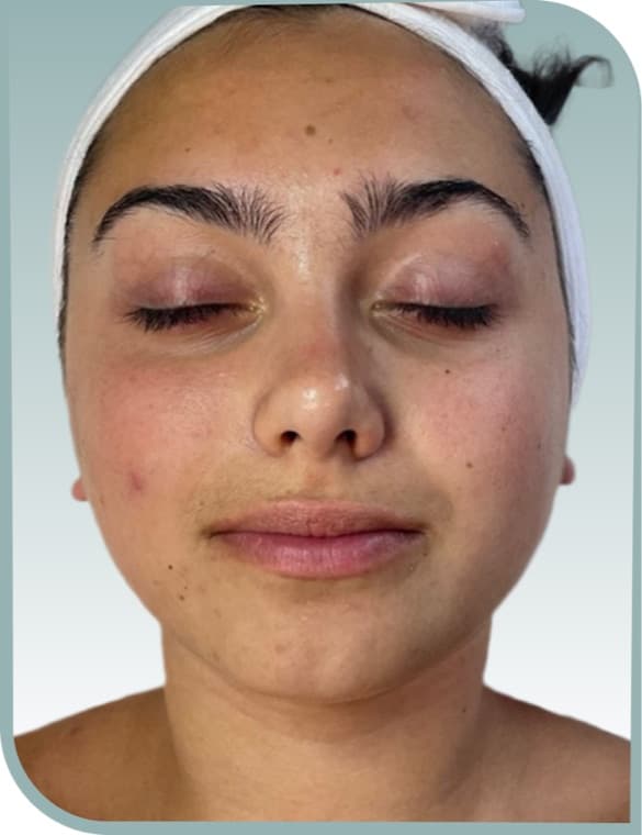 Blotchy redness, After photo (result 8 of 10)