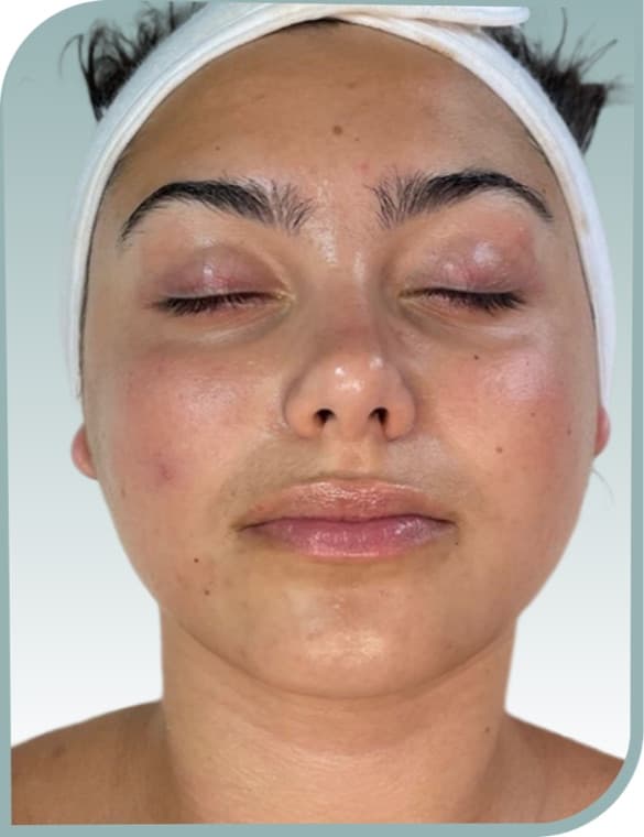 Blotchy redness, Before photo (result 8 of 10)