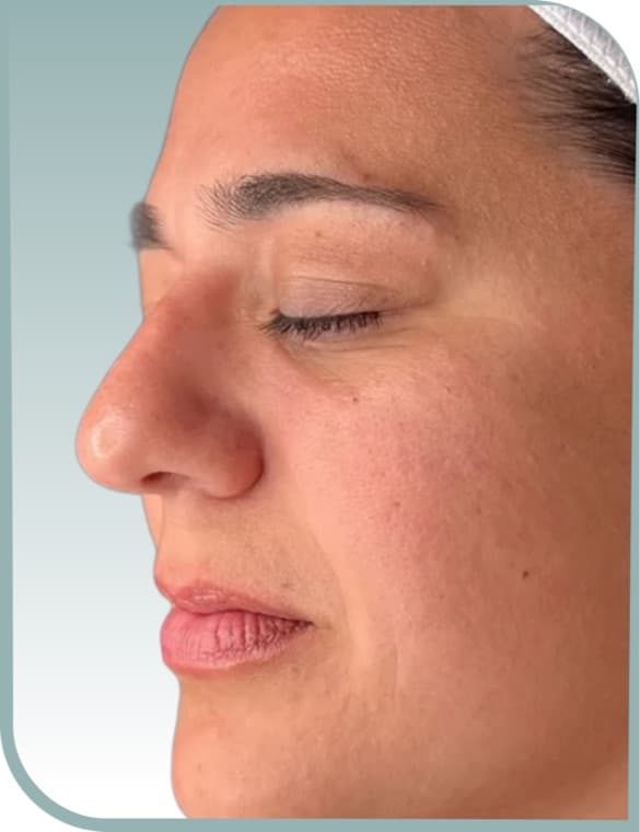 Skin texture, Before photo (result 9 of 10)