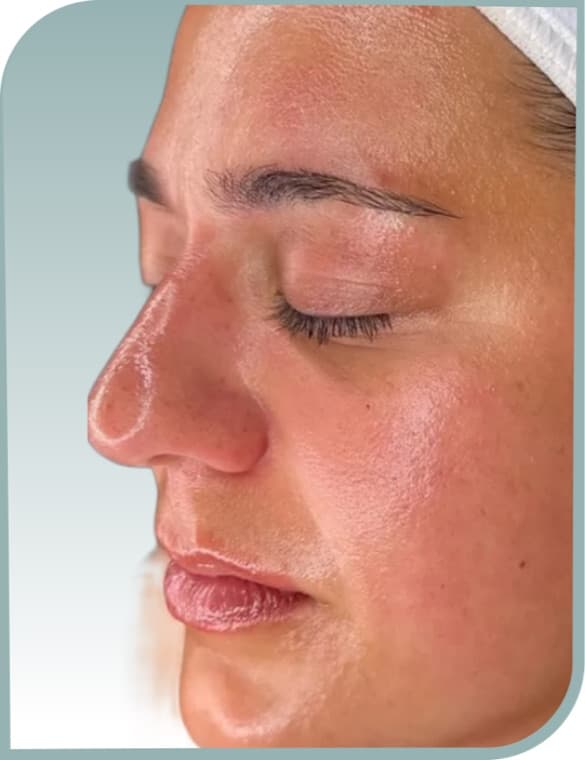Skin texture, After photo (result 9 of 10)