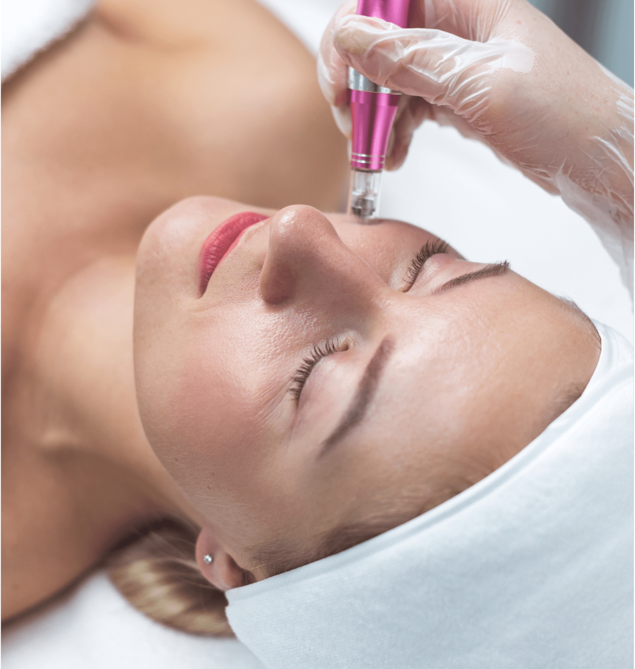 Microneedling treatment at Carisma Aesthetics Malta