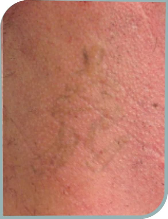 Knee tattoo fading, After photo (result 8 of 10)