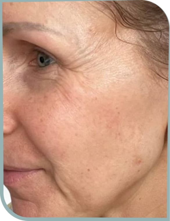 Crepey eye area skin, Before photo (result 1 of 10)