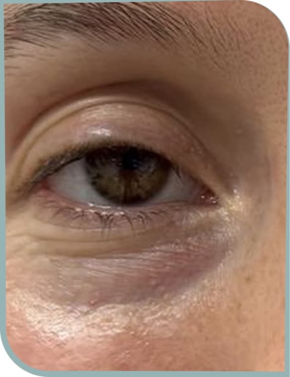 Under eye fine lines, Before photo (result 5 of 10)
