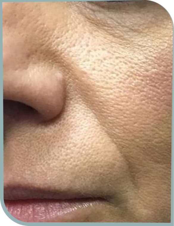 Enlarged cheek pores, Before photo (result 8 of 10)