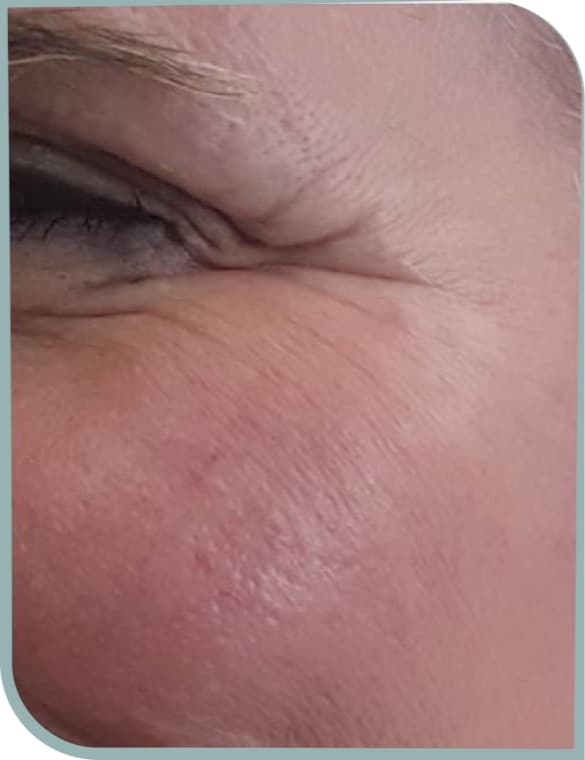 Crow's feet, Before photo (result 1 of 10)