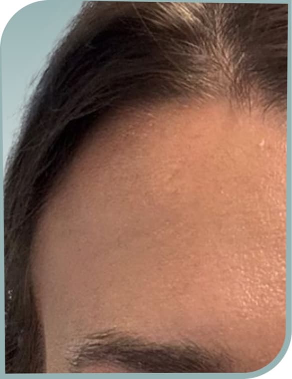 Forehead lines, After photo (result 5 of 10)