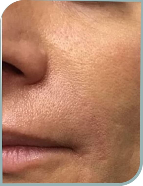 Cheek texture, After photo (result 10 of 10)