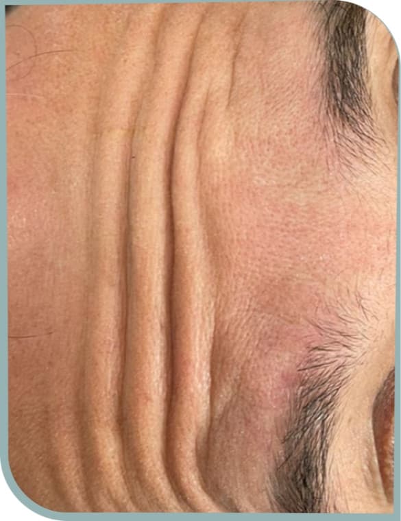 Temple squint lines, Before photo (result 2 of 10)