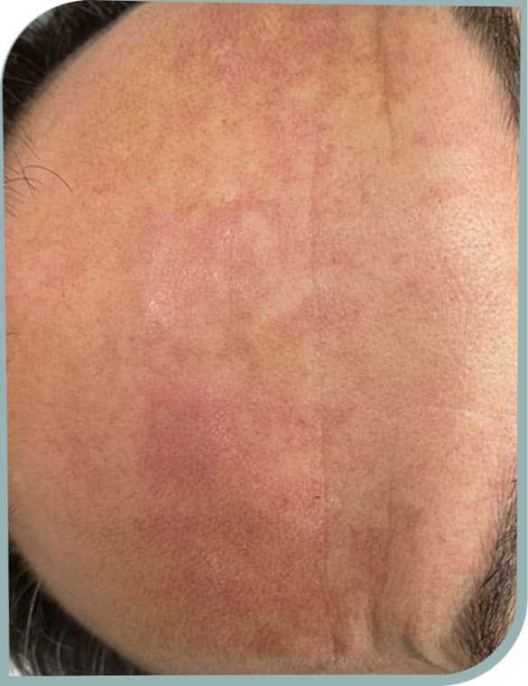 Temple squint lines, After photo (result 2 of 10)