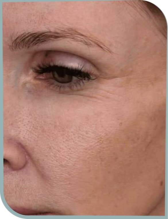 Under eye texture, Before photo (result 3 of 10)