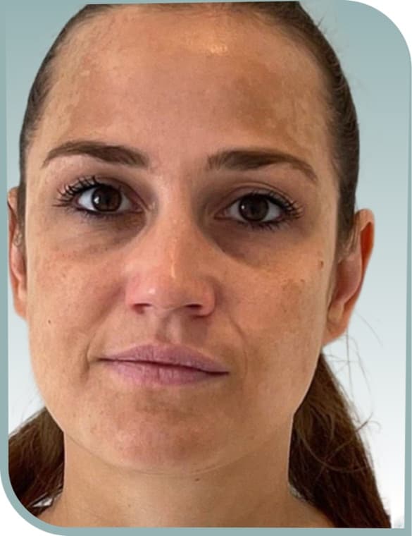 Overall skin quality, Before photo (result 4 of 10)