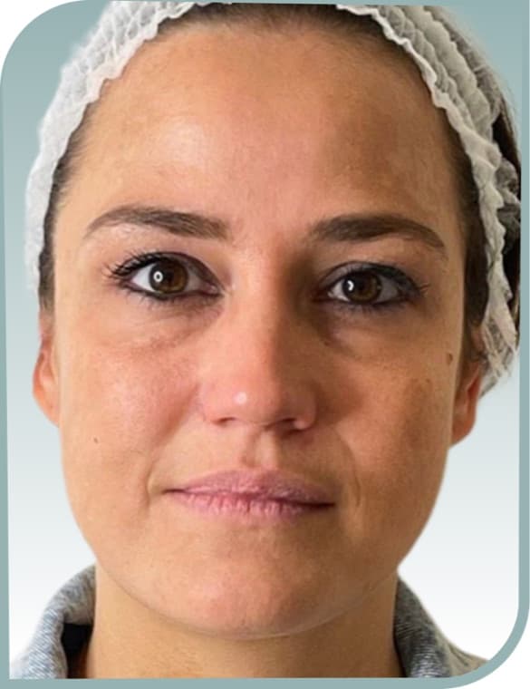 Overall skin quality, After photo (result 4 of 10)