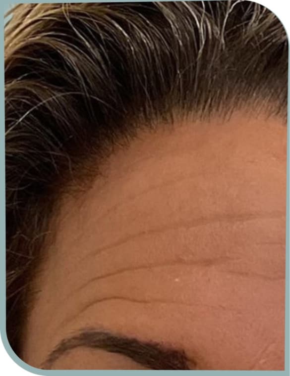 Forehead lines, Before photo (result 5 of 10)