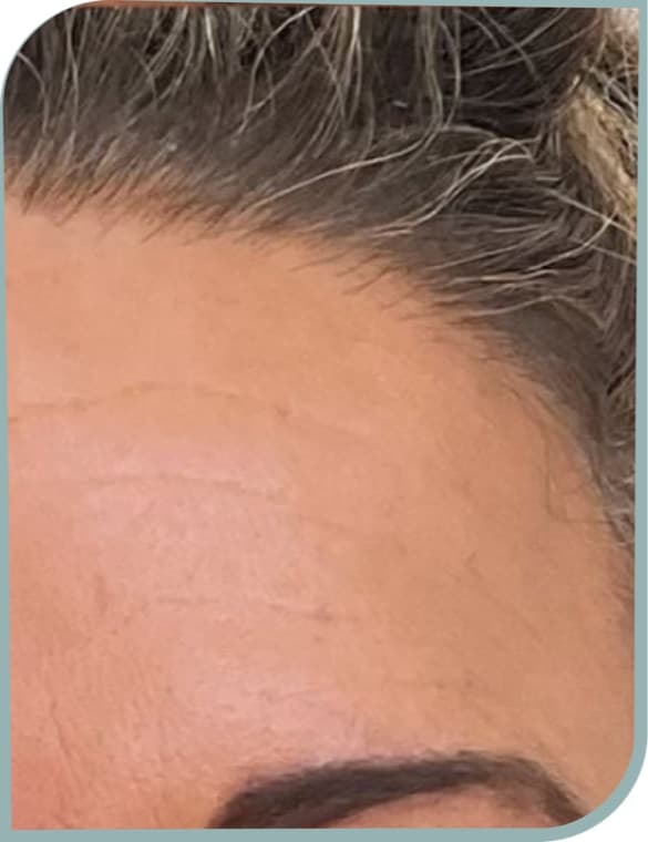 Forehead firmness, Before photo (result 6 of 10)