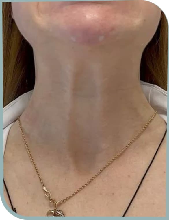 Neck bands, Before photo (result 8 of 10)