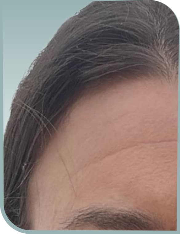 Forehead firmness, After photo (result 6 of 10)