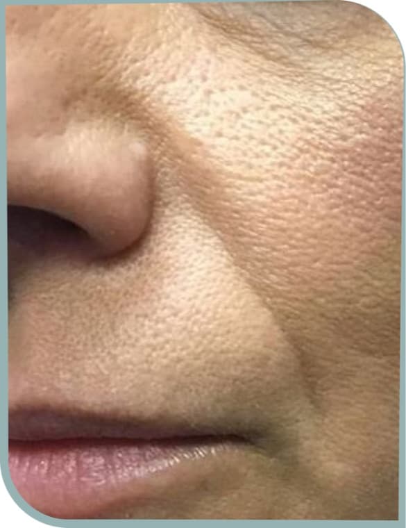 Cheek texture, Before photo (result 10 of 10)