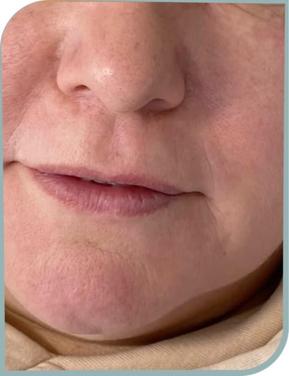 Perioral lines, After photo (result 7 of 10)