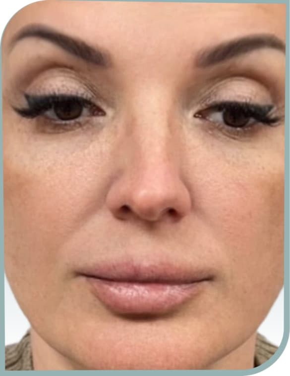 Under eye area, After photo (result 9 of 10)