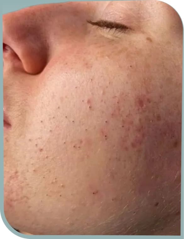 Pigmentation on cheek, Before photo (result 2 of 10)