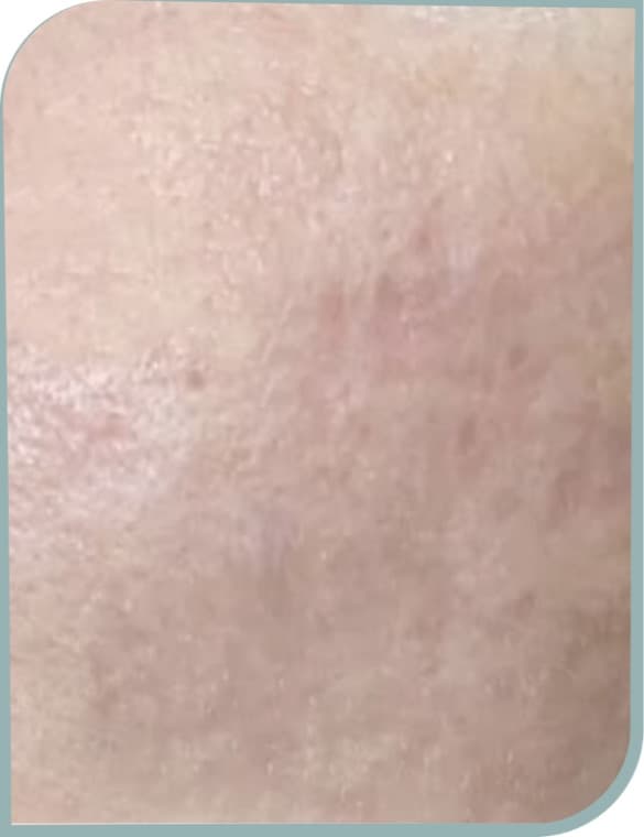Indented acne scars, After photo (result 10 of 10)