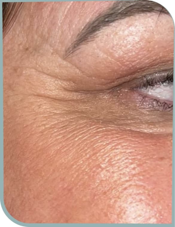 Crow's feet wrinkles, Before photo (result 3 of 10)