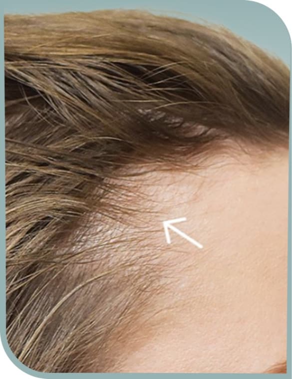 Thinning temple hairline, Before photo (result 4 of 10)