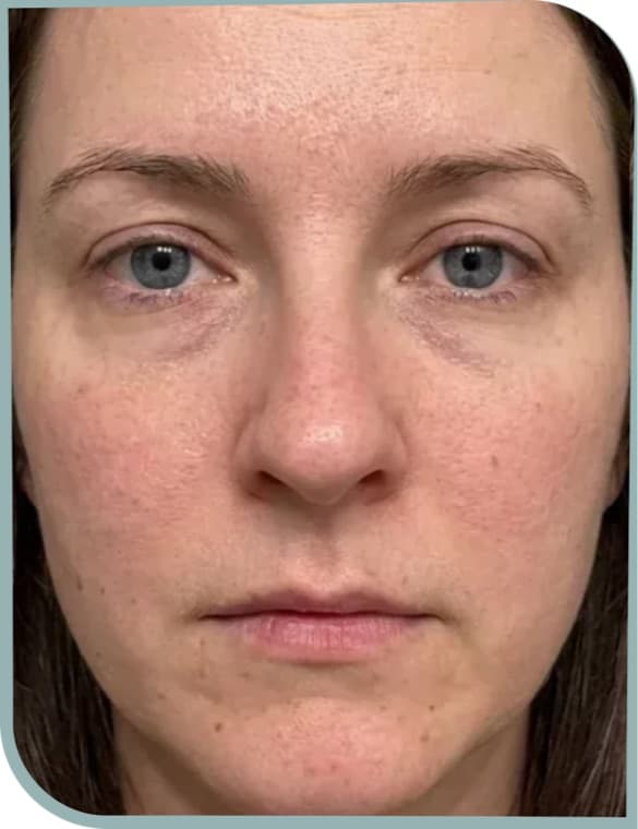 Dull tired skin, Before photo (result 5 of 10)