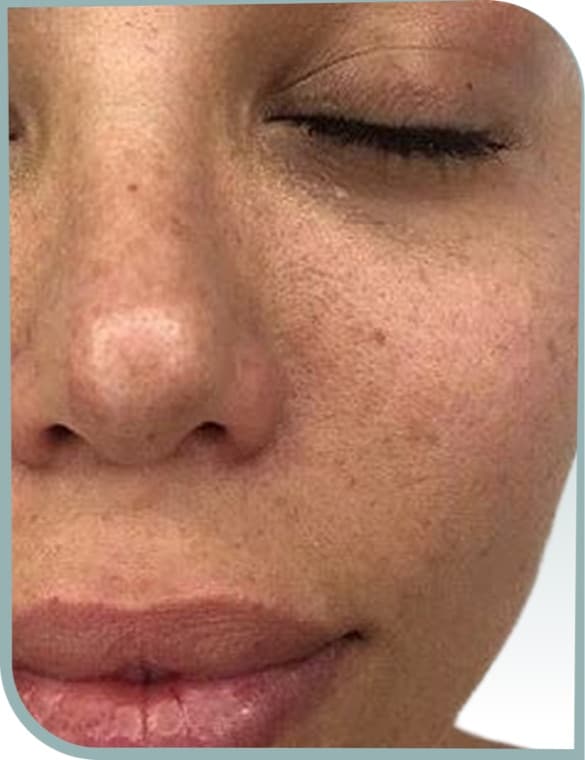 Cheek pigmentation, Before photo (result 6 of 10)