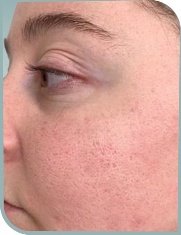 Enlarged pores on cheek, Before photo (result 8 of 10)