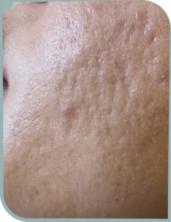 Indented acne scars, Before photo (result 10 of 10)