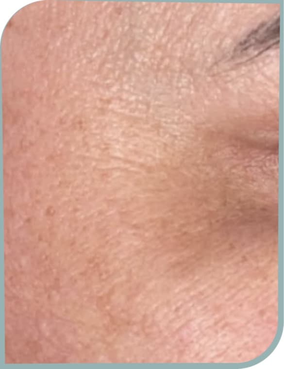 Crow's feet wrinkles, After photo (result 3 of 10)