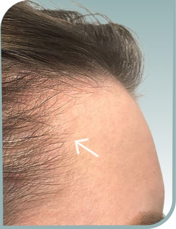 Thinning temple hairline, After photo (result 4 of 10)