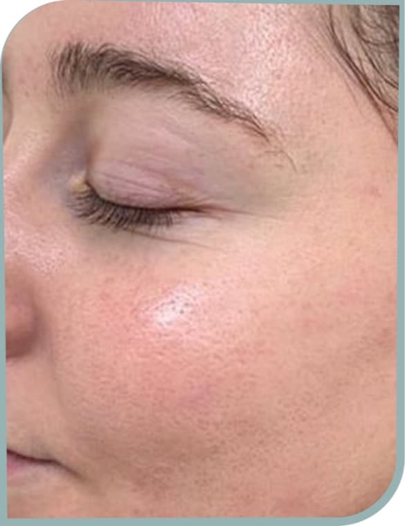 Enlarged pores on cheek, After photo (result 8 of 10)