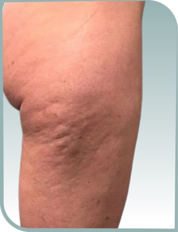 Thigh dimpling, Before photo (result 2 of 10)