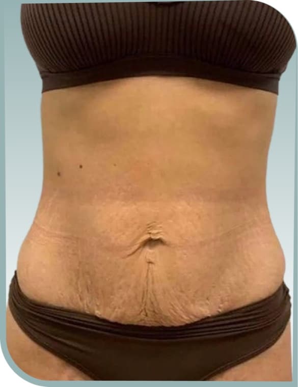 Abdominal laxity, Before photo (result 3 of 10)