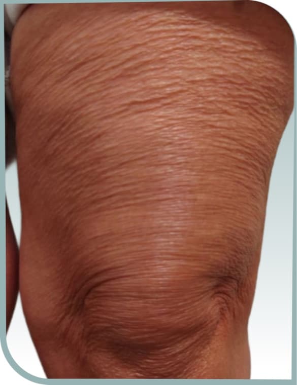 Above-knee crepiness, Before photo (result 7 of 10)