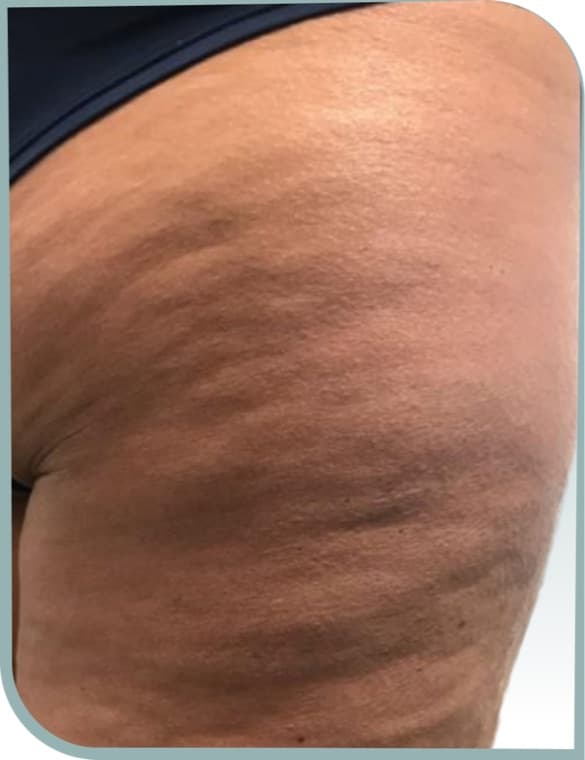 Outer thigh cellulite, Before photo (result 9 of 10)