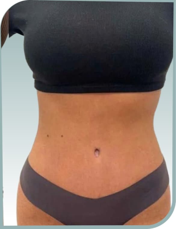Abdominal laxity, After photo (result 3 of 10)