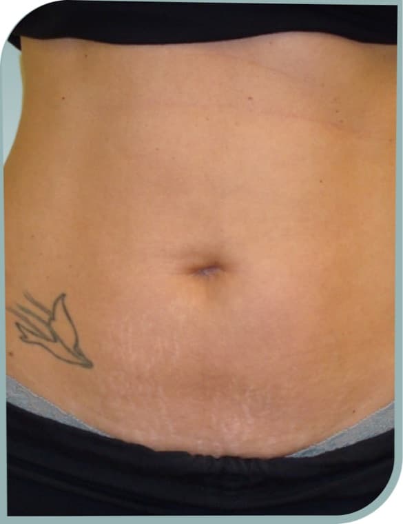 Lower belly laxity, After photo (result 5 of 10)