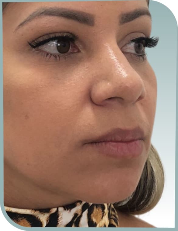 Jawline definition, Before photo (result 1 of 10)