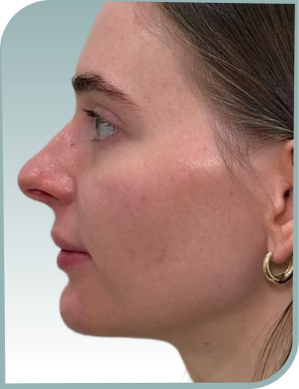 Jaw and chin shaping, After photo (result 9 of 10)