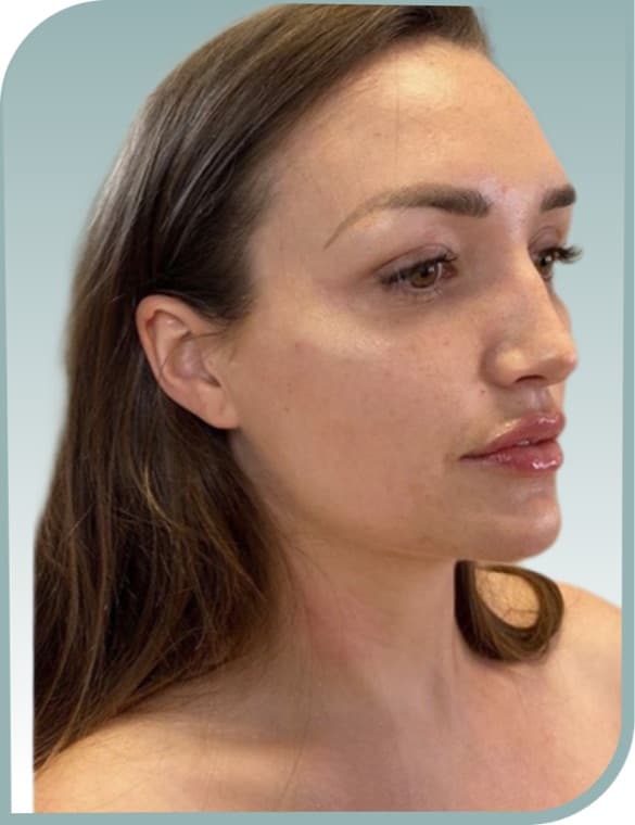 Jawline shaping, After photo (result 6 of 6)