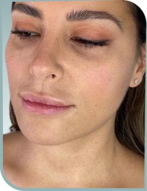 Lower face contour, Before photo (result 3 of 10)